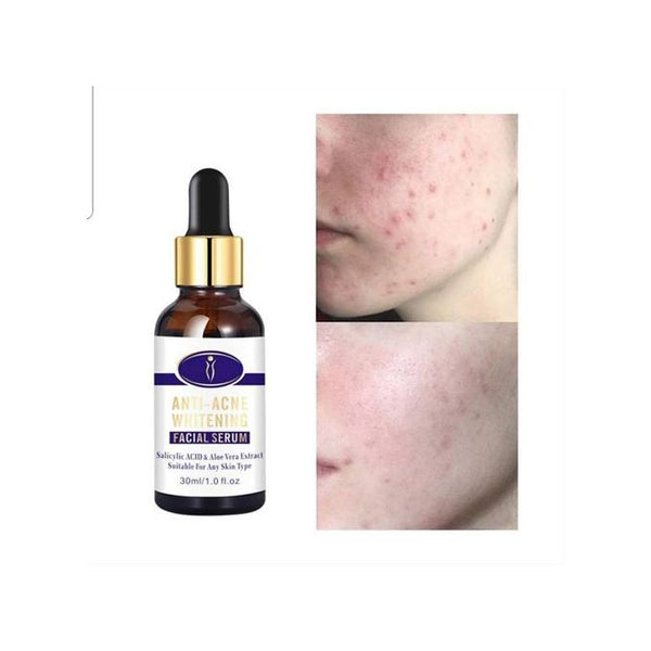 Aichun Beauty Anti Acne Whitening Facial Serum